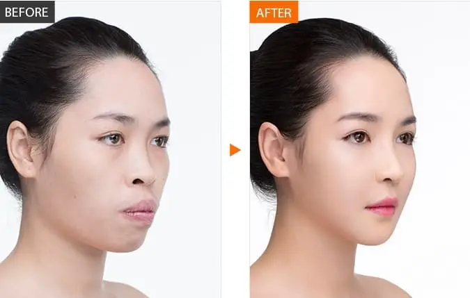 Phẫu Thuật Hàm Mặt Có Thể Mang Đến Nhiều Lợi Ích Về Thẩm Mỹ Và Sức Khỏe