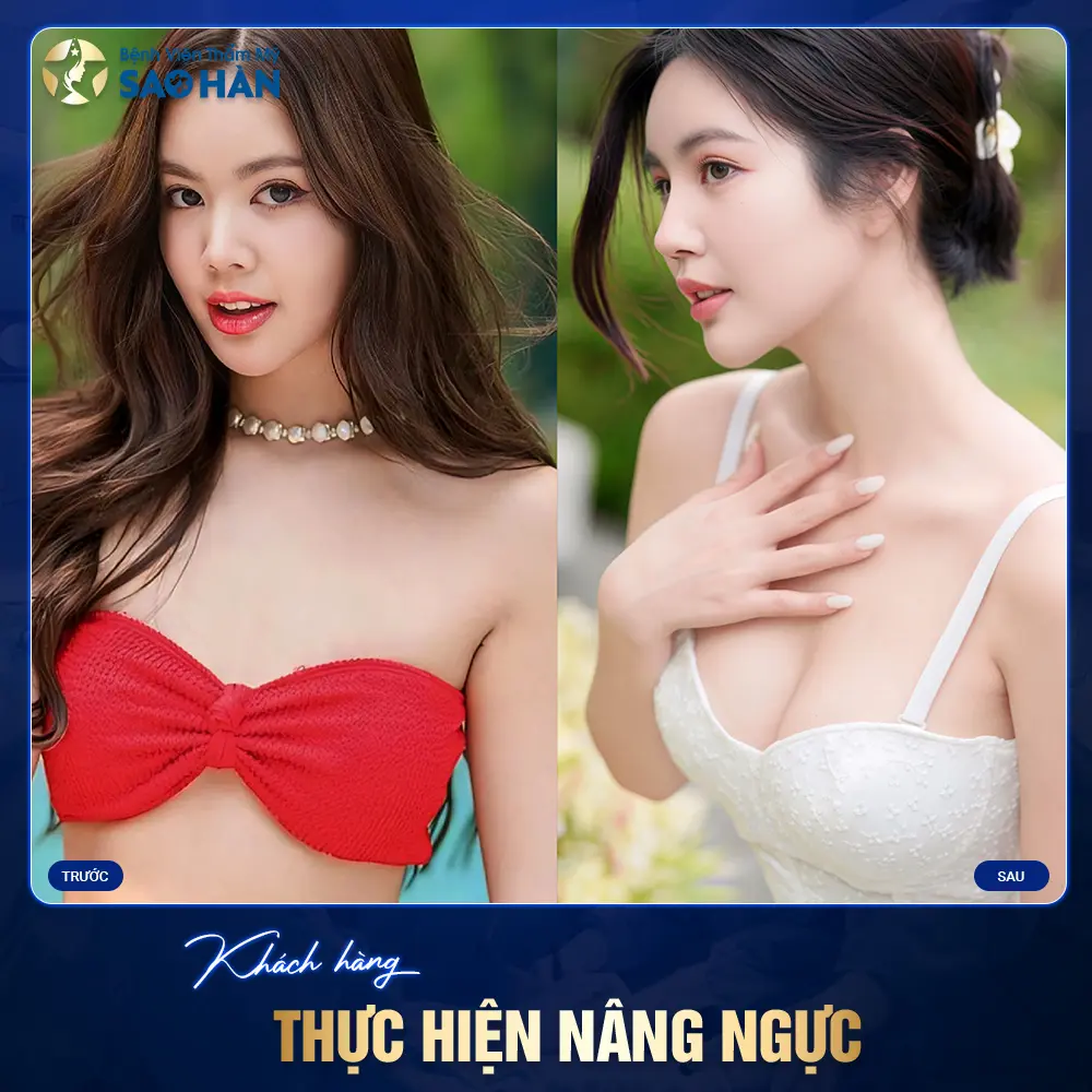 Hình Ảnh Khách Hàng Sau Khi Phẫu Thuật Nâng Ngực 