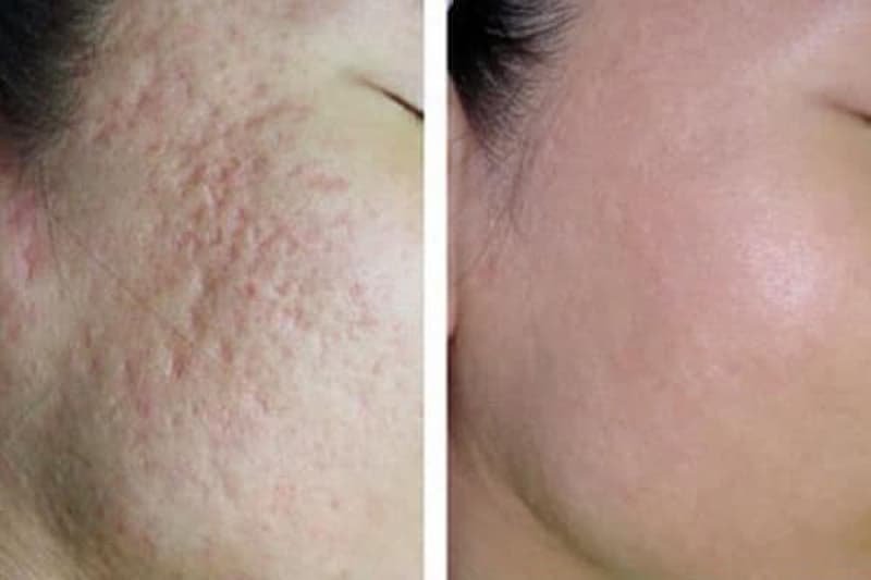 Hình Ảnh Khách Hàng Sau Sau Khi Thực Hiện Xong Liệu Trình Bắn Laser