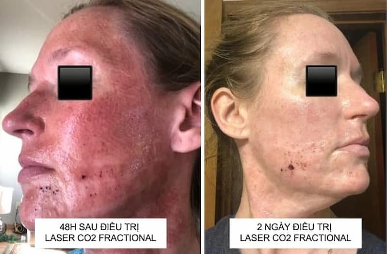 Dù Được Đánh Giá Ít Gây Tổn Thương Và Có Thời Gian Nghỉ Dưỡng Ngắn Nhưng Laser Co2 Fractional Vẫn Gây Ảnh Hưởng Sau Quá Trình Điều Trị Da,