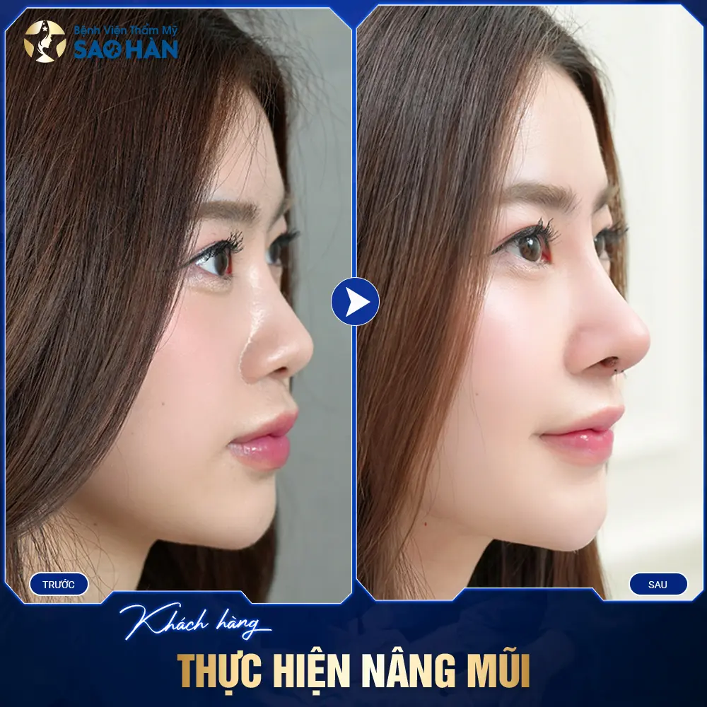 Hình Ảnh Thực Tế Ca Nâng Mũi Tại Sao Hàn 