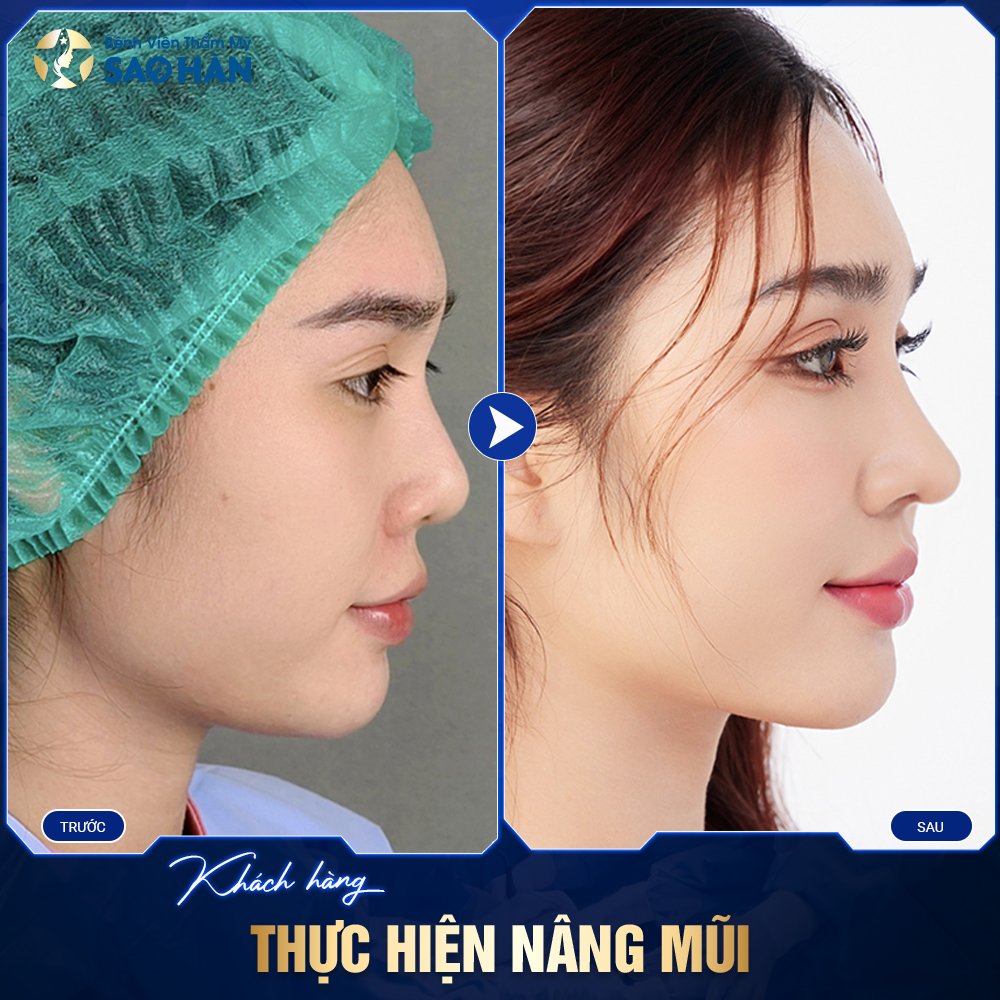 Có Nhiều Phương Pháp Giúp Bạn Sở Hữu Dáng Mũi Ưng Ý