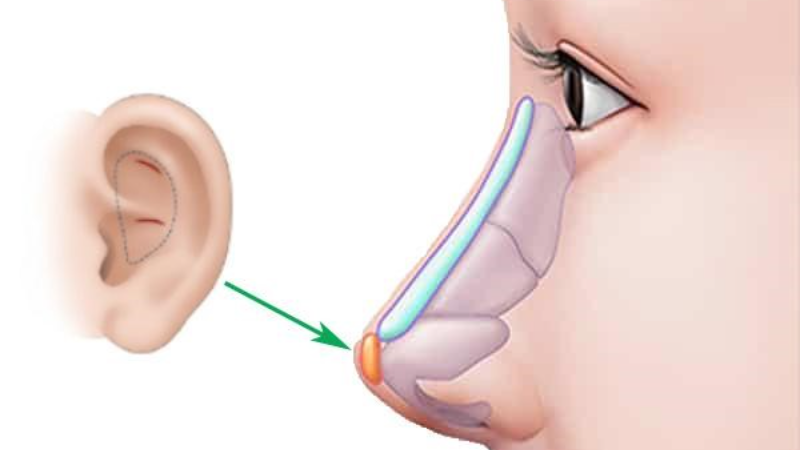 Sụn Tự Thân Có Khả Năng Tương Thích Rất Cao, Ít Gây Ra Biến Chứng