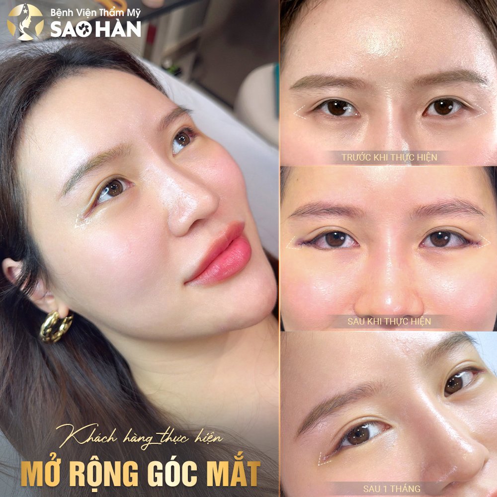 Hình Ảnh Khách Hàng Mở Rộng Góc Mắt