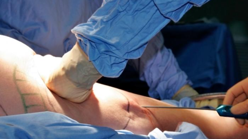 Liposuction Operation