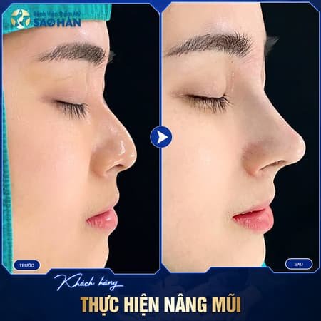 Nang Mui Cau Truc Pureform 4