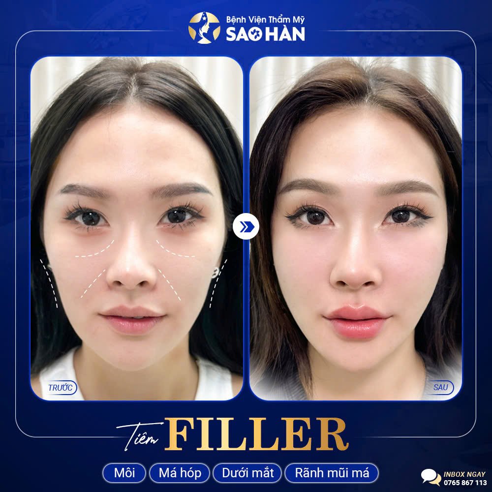 Khách Hàng Tiêm Filler Tại Bệnh Viện Thẩm Mỹ Sao Hàn